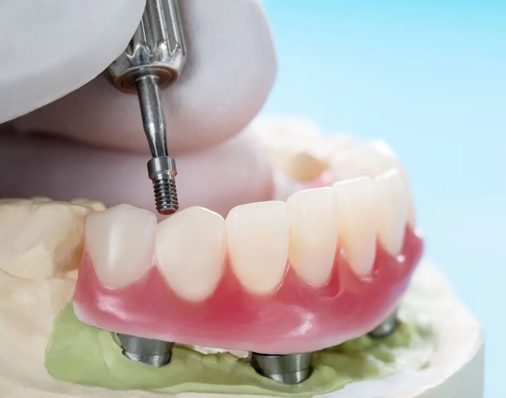 4 Dental Implants