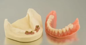 All on 4 Dental Implants The Solution for a Complete Smile Makeover