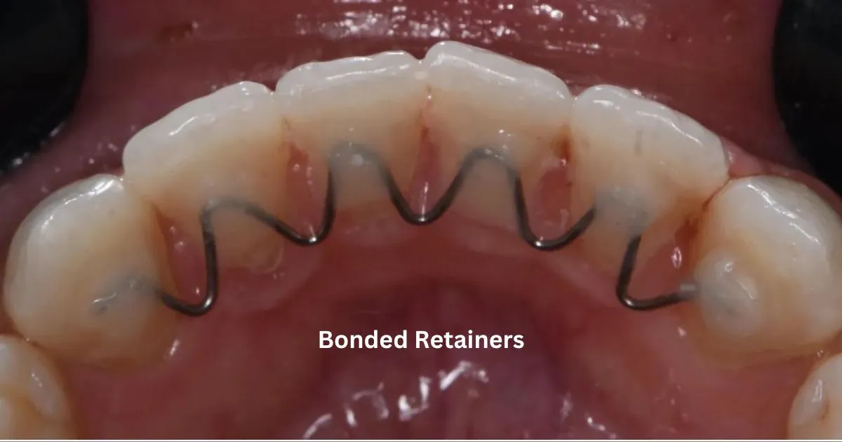 Bonded Retainers Dental Office Network Search, Find And Review
