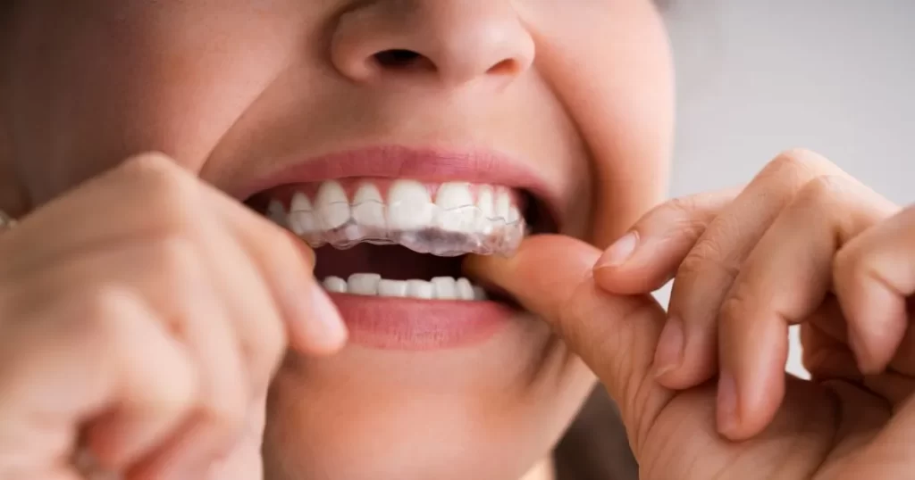 Clear Aligners