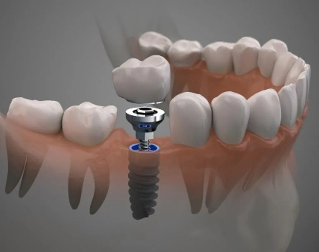 DENTAL IMPLANTS FOR MISSING MOLARS