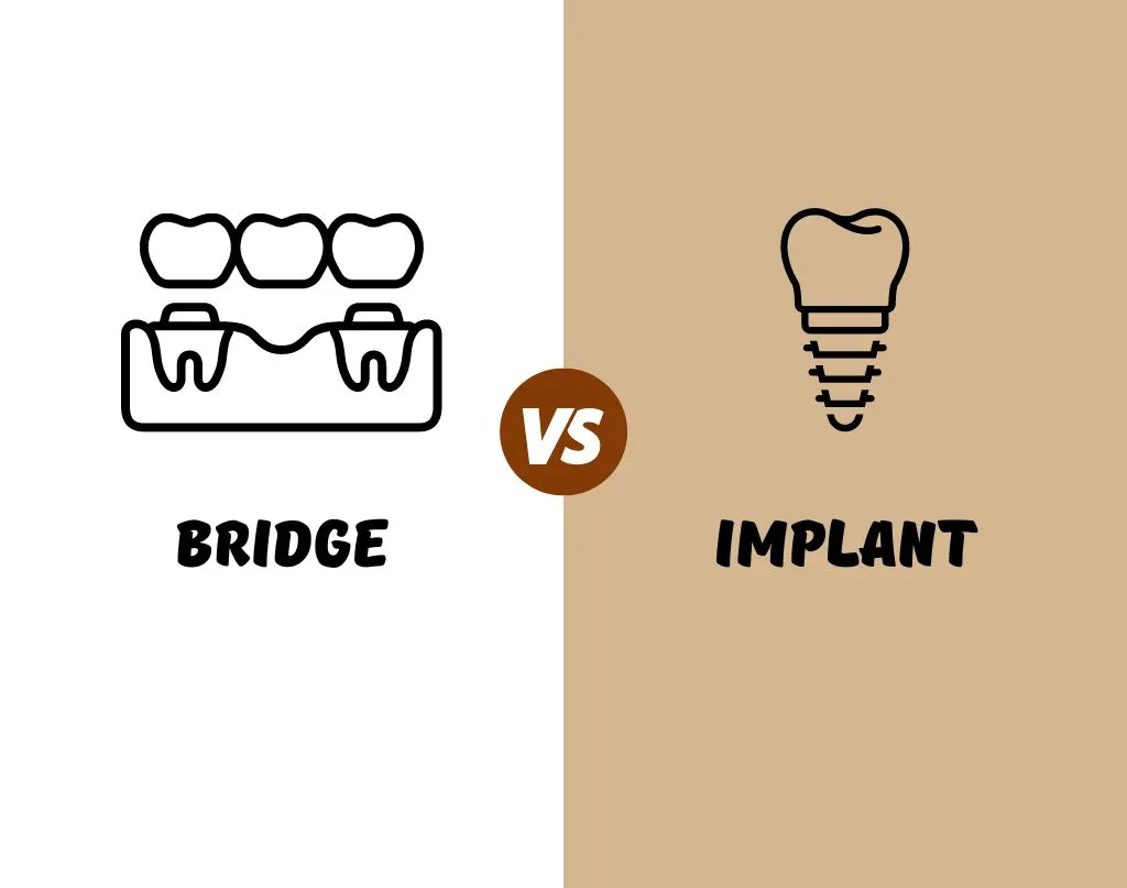 Dental Bridge Vs Implant