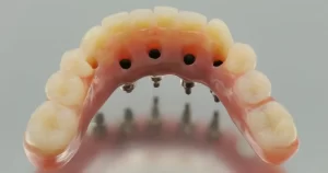 Dental Implant-Supported Dentures Everything You Need to Know