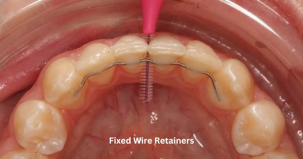 How Custom Invisalign Retainers Are Fitted and Made - Carolina