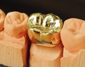 Gold Dental Crowns - Dental Office Network | Search, Find And Review ...