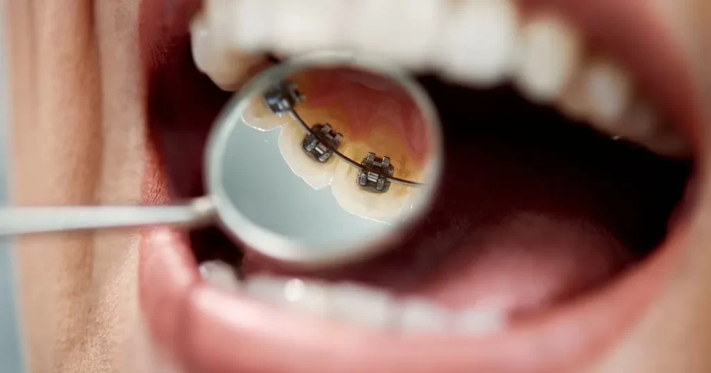 Lingual Braces