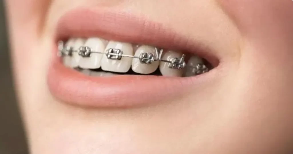 METAL BRACES