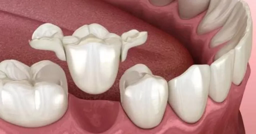 Maryland Dental Bridge