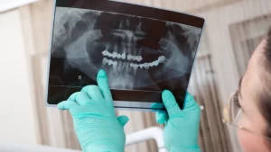 Benefits of the All-on-4 Dental Implant Procedure.