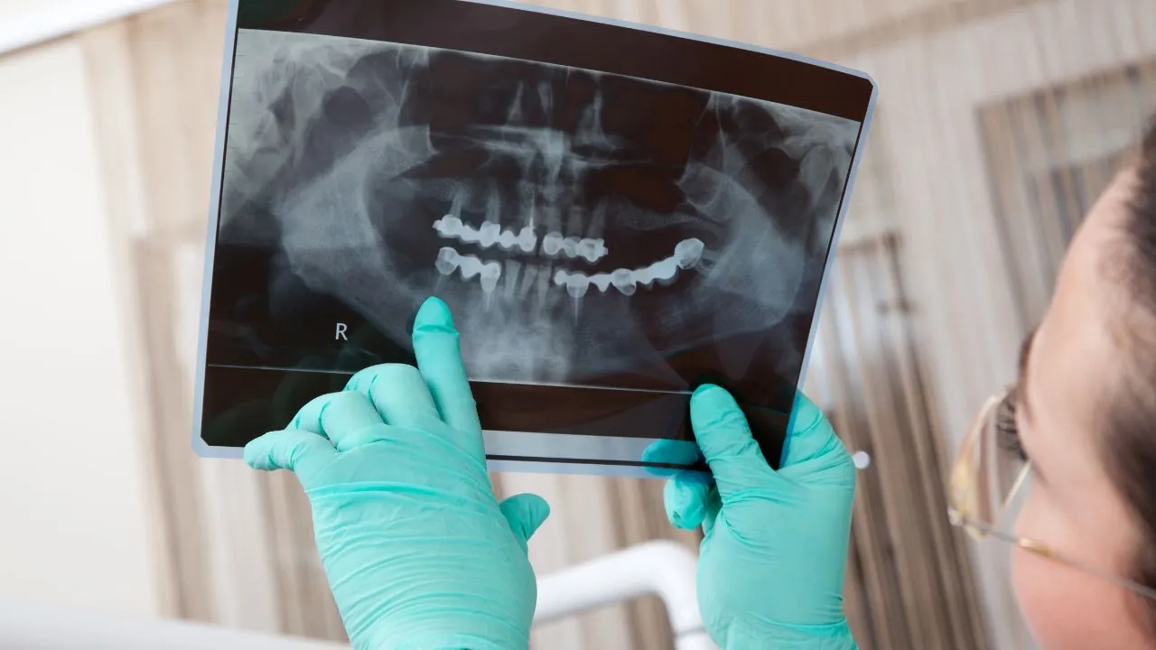 Benefits of the All-on-4 Dental Implant Procedure.