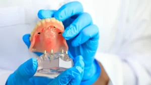 What Makes The All On 4 Dental Implant Procedure Different?
