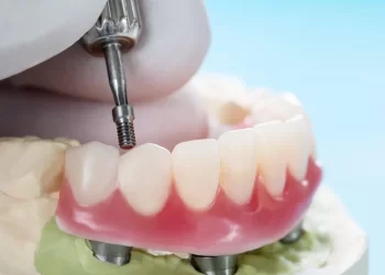 4 Dental Implants