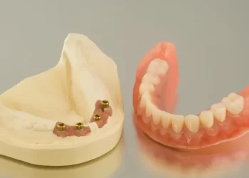 All on 4 Dental Implants The Solution for a Complete Smile Makeover
