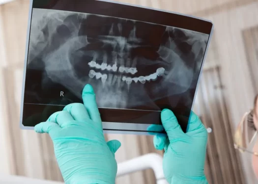 Benefits of the All-on-4 Dental Implant Procedure.