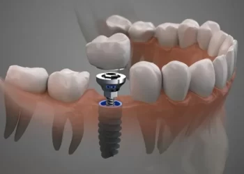 DENTAL IMPLANTS FOR MISSING MOLARS