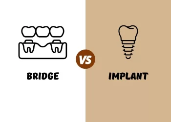 Dental Bridge Vs Implant