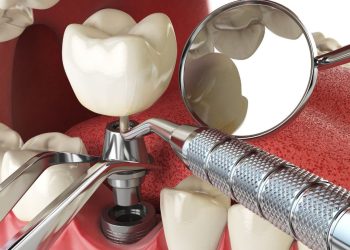 Dental Implant (1)