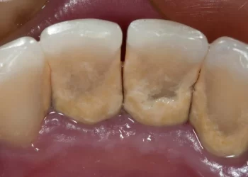 Dental Plaque Causes, Treatment, and the Role of Dental Probiotics