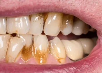Dental Tartar Causes, Treatment, and Prevention