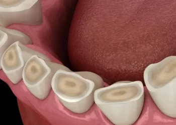 Understanding Bruxism Causes, Symptoms, and Treatment