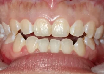 Understanding Dental Malocclusion Causes, Symptoms, and Treatment Options