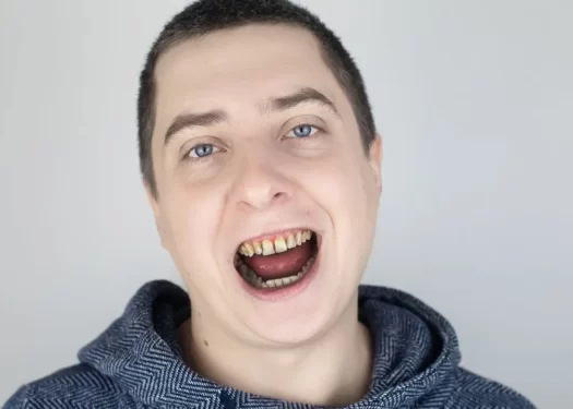 Who is a Suitable Candidate for the All-on-4 Dental Implant Procedure?